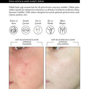 KOREACO anti acne serum